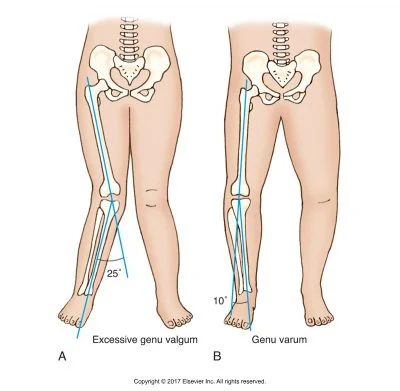 Learning from Dancers to Prevent Non-Contact ACL Injuries 2 ACL injuries